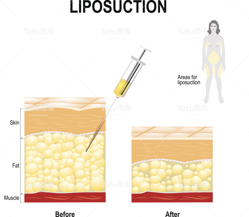 抽脂前后的人体皮肤层